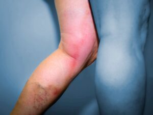 عوارض واریس پا