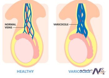 عوارض واریس بیضه