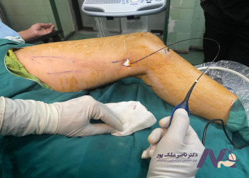 هزینه لیزر rf برای درمان واریس