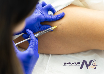 هزینه اسکلروتراپی واریس 