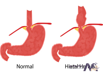 Hiatal-hernia-treatment درمان فتق هیاتال