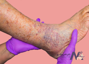 Muscle-cramps-complication-of-varicose-veins in-legs. گرفتگی عضلات از عوارض واریس پا