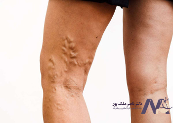 Photo-of-cord-varicose-veins عکس واریس طنابی یا شاخه ای