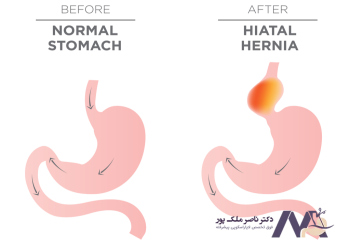 Photo-of-esophageal-hernia عکس فتق مری