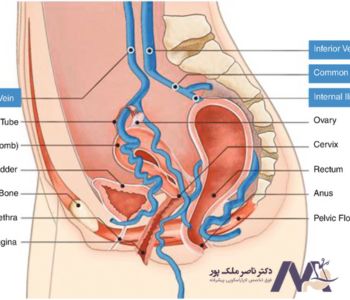عکس واریس واژن در بارداری