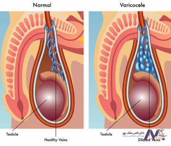 خطرات واریس بیضه