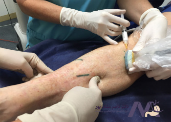 اسکلروتراپی وریدهای دست