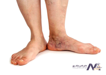 Spider-veins-of-the-ankle واریس عنکبوتی مچ پا
