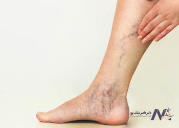 Symptoms-of-spider-veins علائم رگ های عنکبوتی
