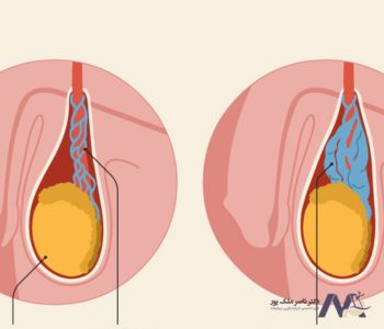 علائم واریس بیضه