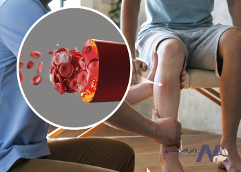 The-most-important-complications-of-varicose-veins مهم ترین عوارض واریس پا