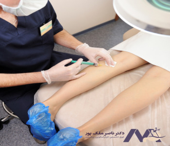 درمان واریس با تزریق