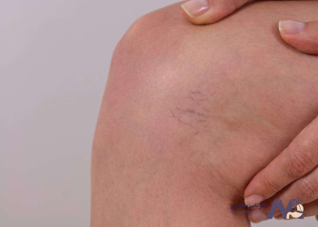 causes-spider-veins-to-appear علت نمایان شدن واریس عنکبوتی