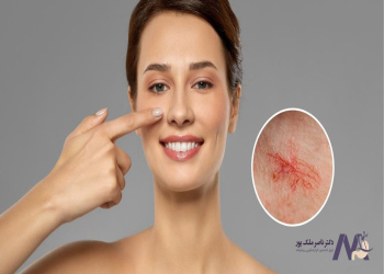 home-treatment-for-facial-spider-veins درمان خانگی رگهای عنکبوتی صورت