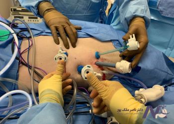 هزینه انواع عمل لاپاراسکوپی