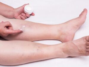 پماد برای درمان واریس