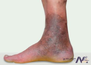 The-cause-of-varicose-veins علت زخم واریس