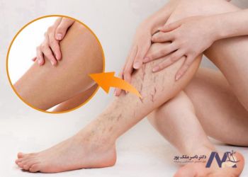 The-effectiveness-of-ointment-in-treating-varicose-veins تاثیر گذاری پماد در درمان واریس