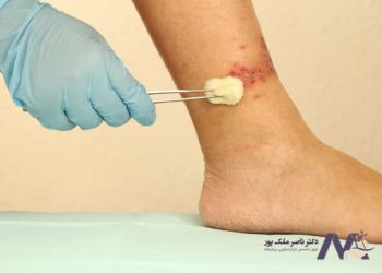 Treatment-of-varicose-veins درمان زخم واریس