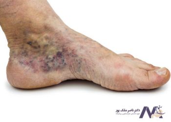 Varicose-wound-photo عکس زخم واریس
