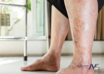 علل درد پا بعد از اسلیو معده