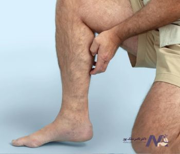 علل واریس پا در مردان