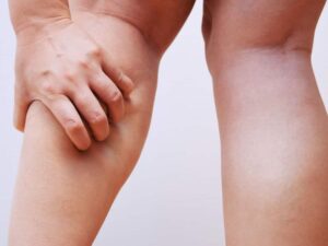 درد پا بعد از اسلیو معده