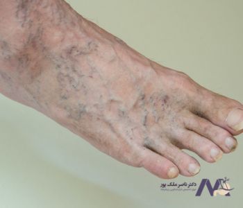 کاهش تاثیر پوشیدن کفش پاشنه بلند بر واریس 