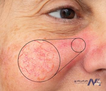 علائم واریس صورت