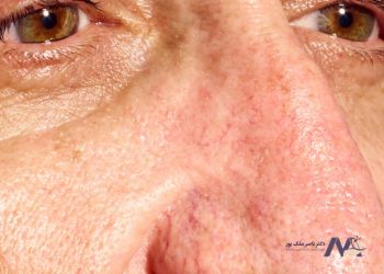 درمان واریس صورت