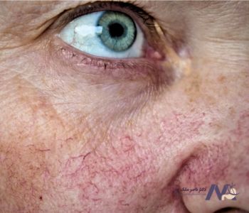 انواع رگ های واریسی صورت