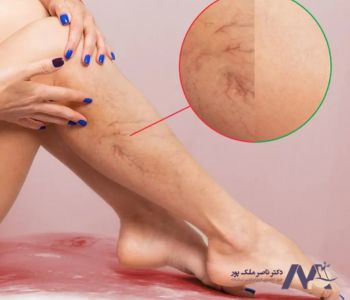 علت تاثیر پوشیدن کفش پاشنه بلند بر واریس